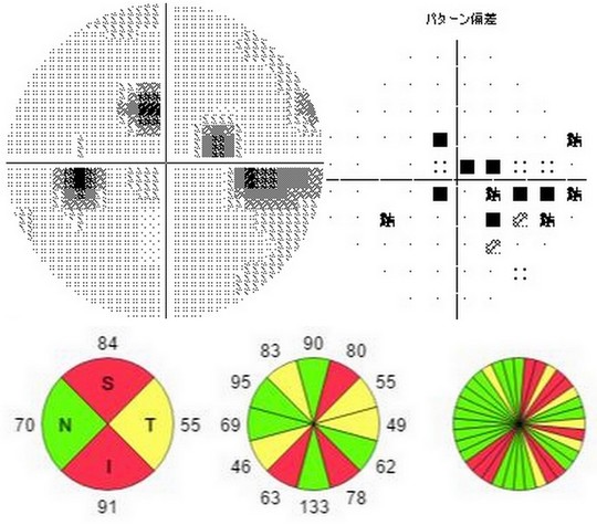 緑内障が気になる方へ 元中村眼科 名古屋市中村区で眼科をお探しなら 元中村眼科